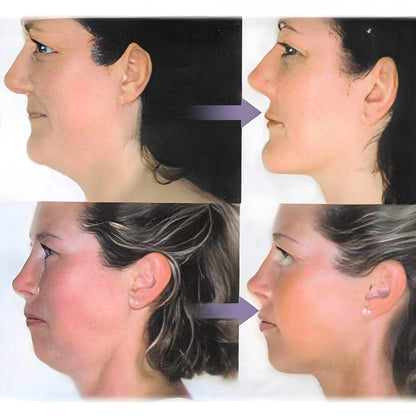 Dispozitiv pentru eliminarea gusei Sbelt Neck Slimmer